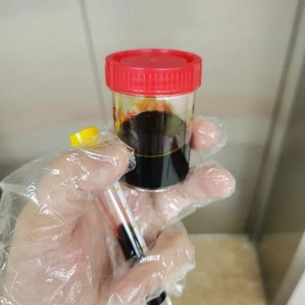 急性肝衰竭！兩兄弟誤吃這種菌 專家提醒